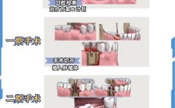 种牙种植体分那几种