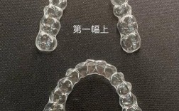 透明牙套正畸效果如何？哪些情况适合选择？