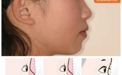 牙齿矫正三年后变形，是矫正失败还是护理不到位？