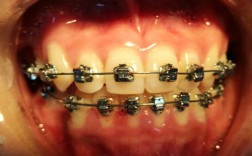 正畸 直丝弓 图片