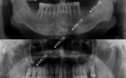种牙能做CT检查吗？