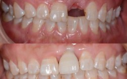 尖牙先天缺失正畸后种植，效果如何保障？