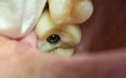 种牙螺丝固位疼不疼？过程有痛感吗？