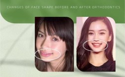 牙齿矫正改变脸型，图片效果真有这么神？