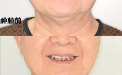 60多岁能种牙吗？高龄种牙受身体状况影响吗？有哪些注意事项需要了解？
