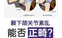 正畸期间 颌关节痛