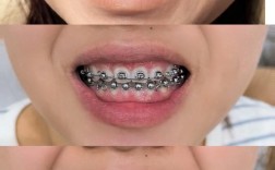 矫正牙齿半年能结束治疗吗？