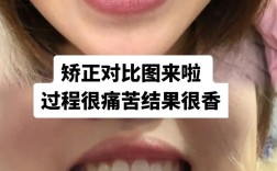 牙齿矫正后悔哭？后悔效果不如预期？还是过程太痛苦？