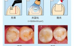 大块充填树脂使用方法