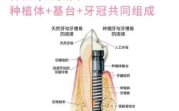 缺牙后正畸和种牙该如何选择？不同缺牙情况下的最佳修复方案是什么？