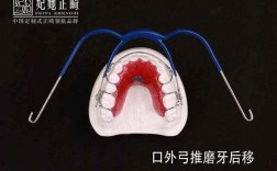 正畸如何移动磨牙？原理与方法是什么？