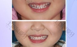 正畸时有乳牙，会影响牙齿矫正效果吗？