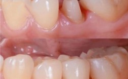 种牙后牙冠高度