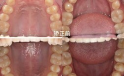 牙齿矫正拔牙不对称，会影响矫正效果和脸型对称性吗？