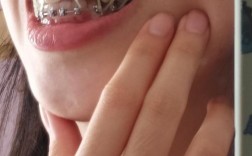 正畸戴皮筋效果真的好吗？一般戴多久才能看到改善？