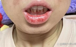 正畸支抗钉后脸肿化脓？怎么回事？原因是什么？