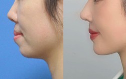 矫正牙齿侧面照