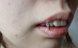 正畸种植钉 出血