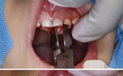 多生牙的治疗方法有哪些？不同年龄或位置的多生牙如何选择最佳治疗方案？治疗过程中需注意哪些关键事项？