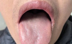 正畸带环牙痛流血是什么原因？