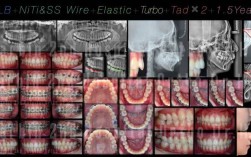 正畸复杂病例入选比赛，评选标准是什么？