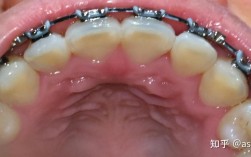 北大口腔正畸失败案例，问题究竟出在哪？