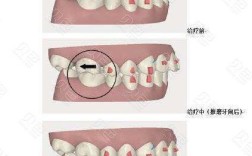 正畸治疗中如何有效预防上颌磨牙前移？