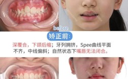 矫正牙齿为什么会导致下颌响？