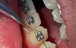 牙齿矫正拆钢丝时，疼吗？后续要注意什么？