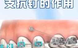 种牙为何要打支抗钉？作用和风险有哪些？