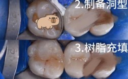 补假牙目前有哪些常见修复方法？不同方法分别适合哪些缺牙情况？