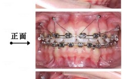 矫正牙齿打种植钉图，种植钉在矫正中起什么作用？