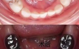 口腔正畸预成冠