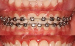 45岁还能牙齿正畸吗？年龄是阻碍吗？