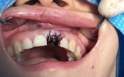 种牙植骨后露出