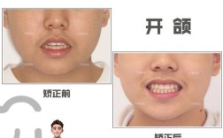 开颌正畸后容易复发吗？如何有效降低复发风险？