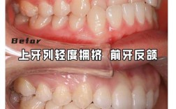 正畸牙齿地包天手术