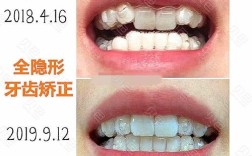 牙科诊所隐形正畸