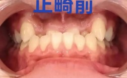 正畸大牙受力前移，这正常吗？为何会这样？
