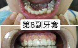 正畸N年后大牙缝，是矫正问题还是其他原因？