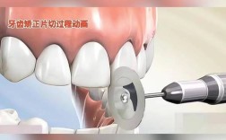 正畸期间补侧切牙可行吗？时机和材料选择要注意什么？