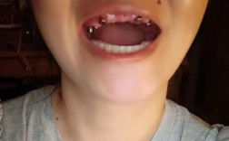 种牙后牙龈形态影响美观，该如何改善？