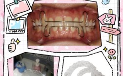 口腔矫正器摘取方法