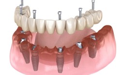 种植欧美牙技术有哪些独特优势？效果与传统种植牙相比如何？