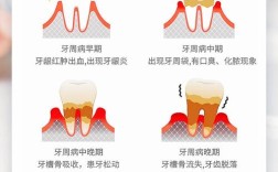 牙周病的保健方法