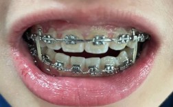 矫正牙齿嘴巴突出是什么原因？该如何有效改善？