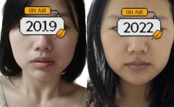 矫正牙齿拔牙脸颊凹