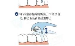 排龈线使用方法有哪些关键步骤？