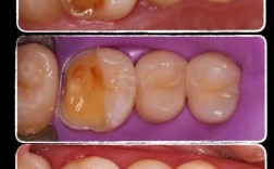 嵌体和植牙有何区别？如何根据牙齿情况选择？