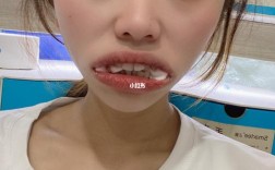 牙齿矫正拔一颗门牙，真的有必要吗？